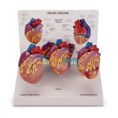 Heart Diseases Model