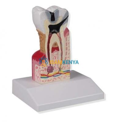 Lower Molar with Caries Model