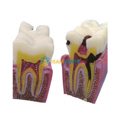 Model Of Decayed Tooth