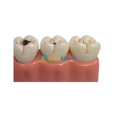 Model of Decayed Teeth