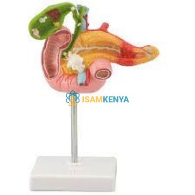 Pathological Model of The Pancreas Duodenum and Gallbladder